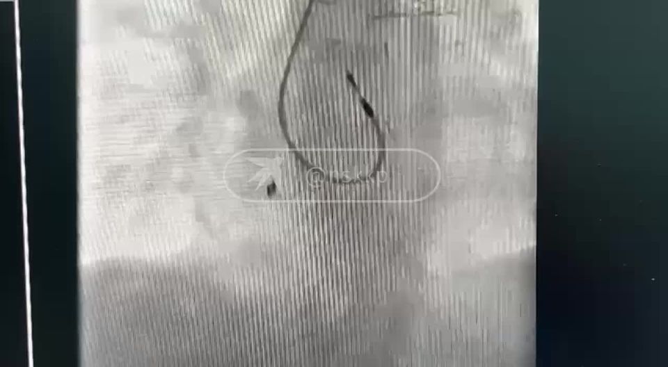 Прокуратура отменила решение о возбуждении дела по факту обнаружения полуметровой струны от катетера в теле ребенка