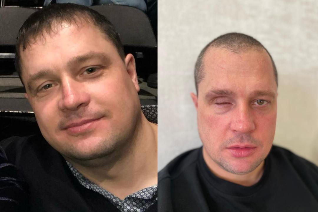 «Я его будил, а он резко вскочил и набросился»: в Новосибирске охранник лишился глаза после драки с пьяным байкером «Я его будил, а он резко вскочил и набросился»: в Новосибирске охранник лишился глаза после драки с пьяным байкером
