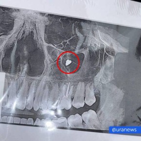 Шесть лет с пломбой в гайморовой пазухе прожила девушка из Новосибирска