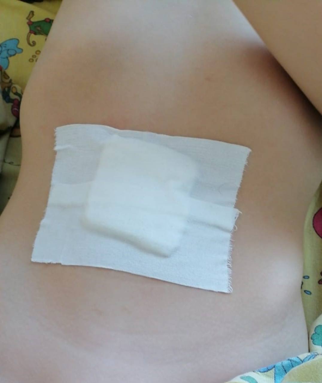 В больнице Искитима 5-летнему ребенку удалили грыжу, которой нет