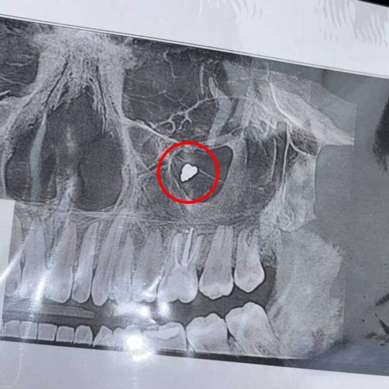 Шесть лет с пломбой в гайморовой пазухе прожила жительница Новосибирска