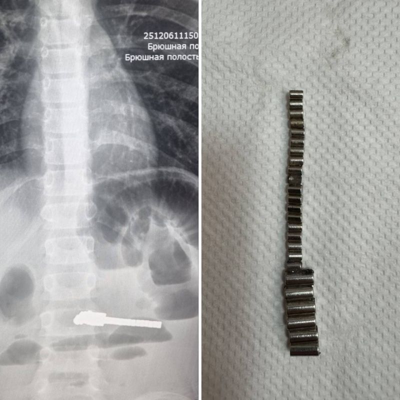 25 магнитиков нашли в кишечнике ребенка новосибирские врачи