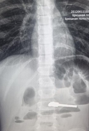 Ребенок проглотил 25 магнитов, которые вызвали непроходимость кишечника, сообщили в Минздраве Новосибирской области