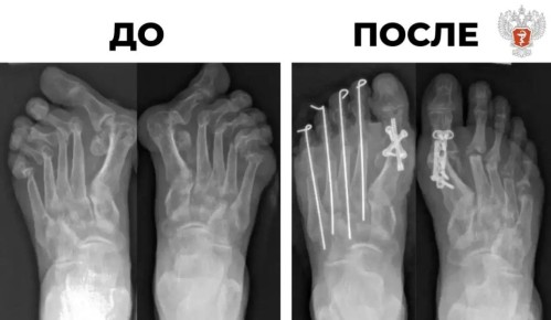 Специалисты федерального центра Минздрава России провели реконструкцию деформированных стоп