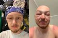 «Я не мог открыть глаз»: у новосибирца распухла голова после катания на сапе